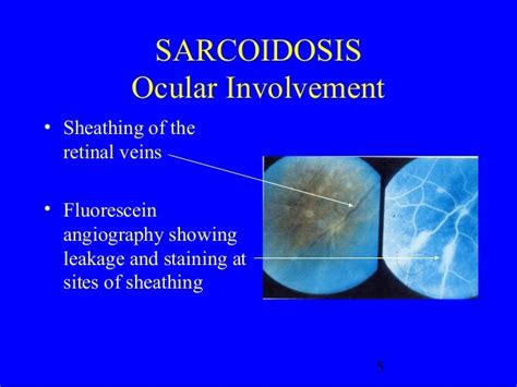 Sarcoidosis