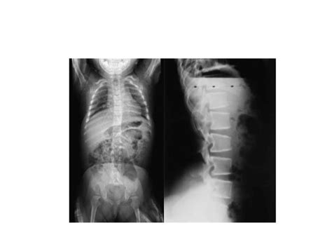 Achondroplasia Hypochondroplasia And Spondyloepiphyseal Dysplasia