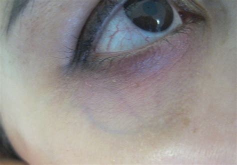 Laser Under Eye Vein Removal Solihull Medical Cosmetic Clinic