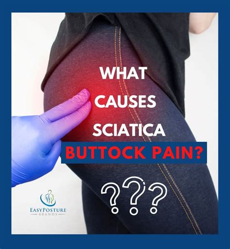 What causes sciatica buttock pain – Artofit