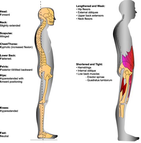 Swayback Posture & Therapy by Dr. Jeffrey Tucker - Dr. Fuji DMS Deep ...