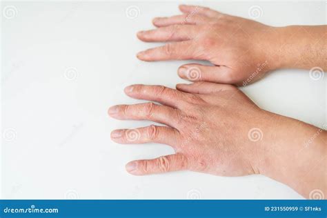 Eczema On The Hands. The Man Applying The Ointment , Creams In The ...