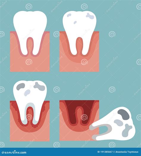 The Stages Of Tooth Decay Flat Vector Illustration Set