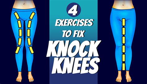 Exercise To Fix Knock Knees Htv