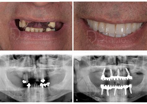 Implantologia Dentale Implantologia Foggia Studio Dentistico Di Stasio