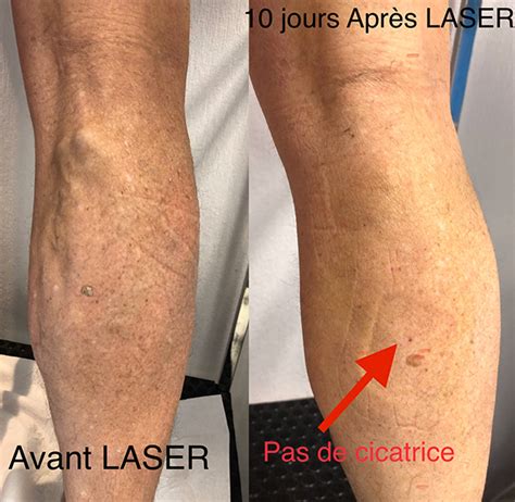 Témoignages Post Opération des Varices au Laser