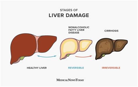 Understanding Enlarged Liver Causes Symptoms And Treatment Ask The