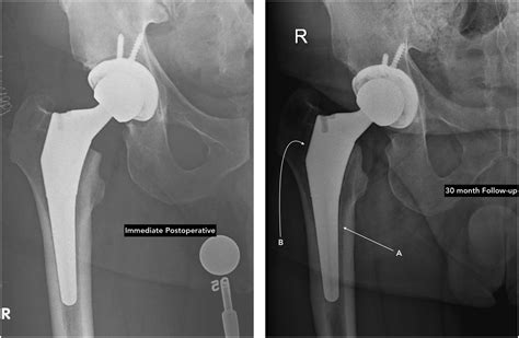 Diagnosis And Detection Of Subtle Aseptic Loosening In Total Hip Arthroplasty The Journal Of