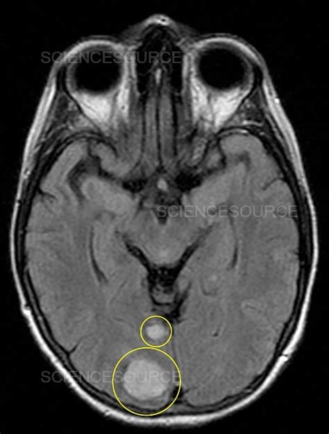 Photograph Brain Cancer Mri Science Source Images