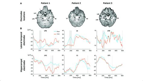 Electrophysiological Results A Depth Electrodes Locations In The