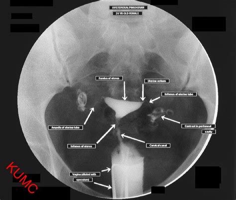 Hsg From Ku Radiographic Anatomy Radiology Imaging Radiology