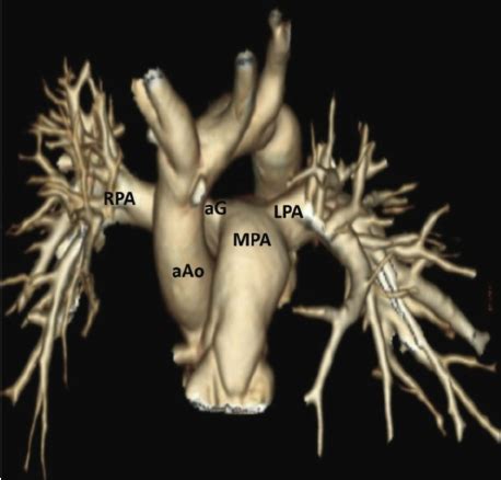 A Postoperative Contrast Enhanced Computed Tomographic Scan