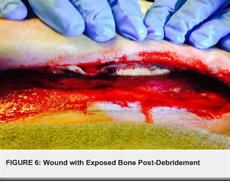 Figure From Treating Fasciotomy Wounds With Negative Pressure Wound