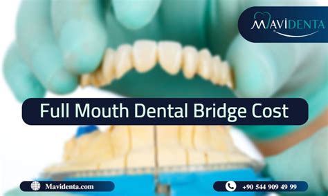 What Factors Affect On Full Mouth Dental Bridge Cost In 2023