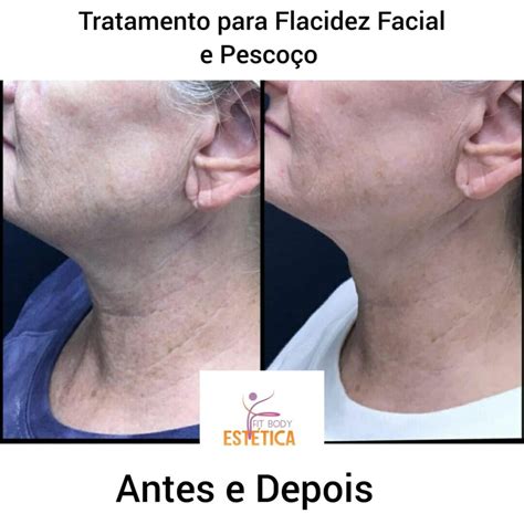 Flacidez Pescoço Antes E Depois - Tratamento para Flacidez Facial e Pescoço - Dra.Sacha