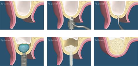 Sinus Lifting Implantodent