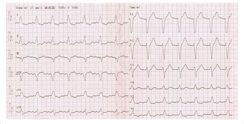 Twelve Lead Electrocardiogram Showing Complete Left Bundle Branch