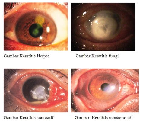 Ghalapulla Keratitis Jamur