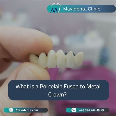 Zirconia Crowns Vs Porcelain Fused To Metal Which Is Right