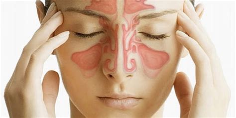 Sinusitis Information Sinus Infection Paris Asthma And Allergy Centers