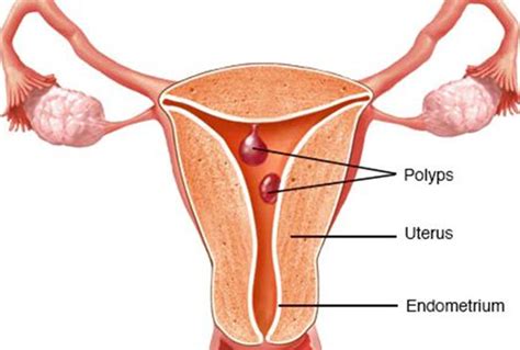 Uterine Polyps Repromed Fertility Center Dallas Tx