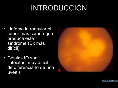 Linfoma Intraocular