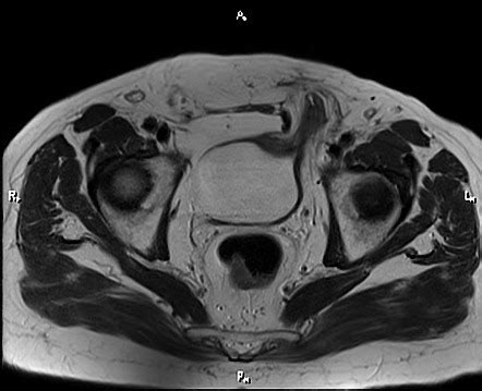 Inguinal Hernia Containing Urinary Bladder Radiology Case