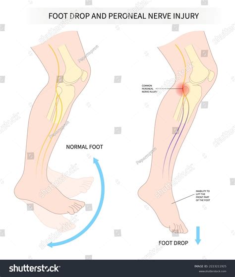 262 Nerve Extension Images, Stock Photos & Vectors | Shutterstock