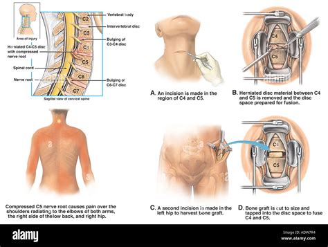 C3 C4 4 5 Traumatismos de la columna cervical con discectomía