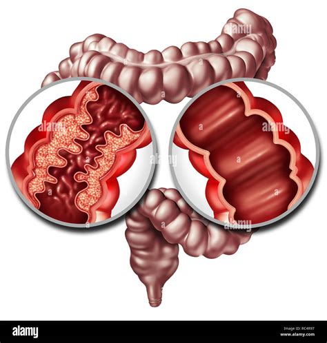 Enfermedad o síndrome de Crohn Enfermedad de Crohn y el colon sano como