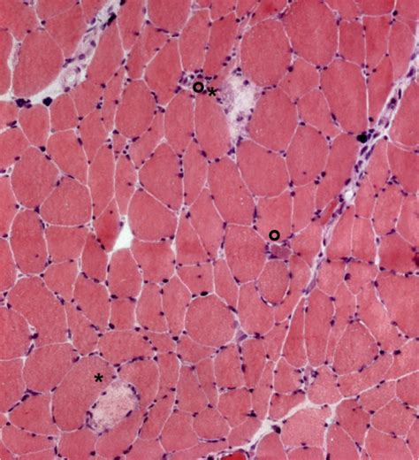 Vastus Lateralis Muscle Biopsy Myopathic Changes With Increased