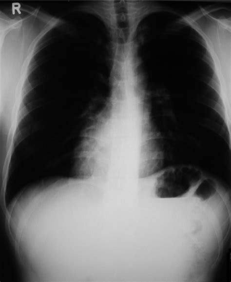 The Patients P A Chest X Ray Showing Isolated Dextrocardia Cardiac