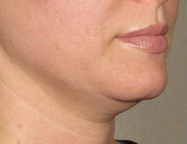 Patient Necks Jawline Before And After Photos Santa Monica