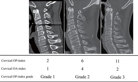 Cervical Ossification Of The Posterior Longitudinal Ligament Index