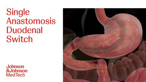 robotic assisted duodenal switch  sally hyland blog