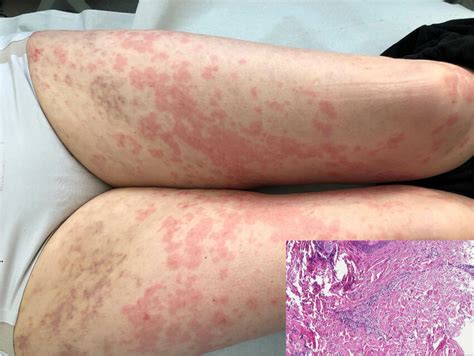 Urticarial And Palpable Non Blanching Purpuric Rash Compatible With Download Scientific Diagram