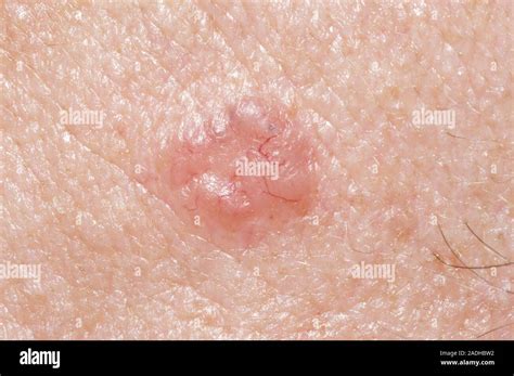 Skin Cancer Nodular Basal Cell Carcinoma On A 75 Year Old Mans Temple