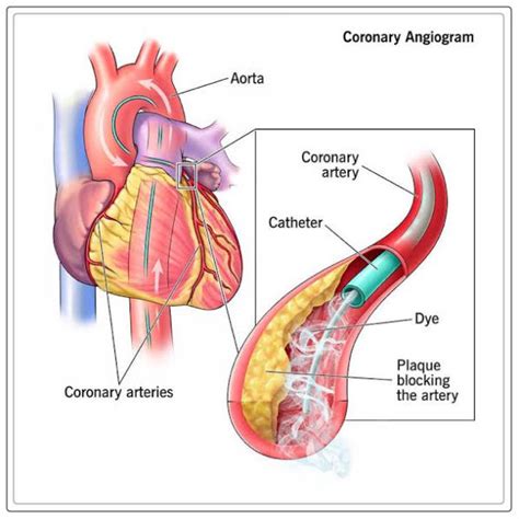 Coronary Angiography: Procedure - Engiomed