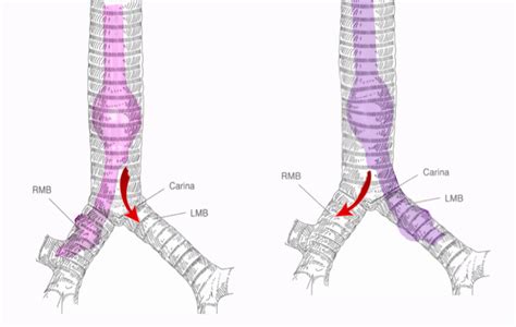 Figure Single Lung Ventilation Image Courtesy S Bhimji Md