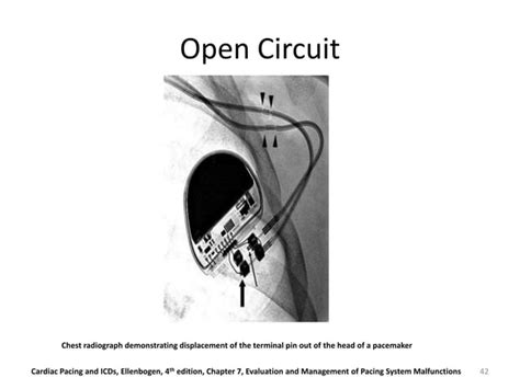 Evaluation And Management Of Pacemaker Malfunction Ppt