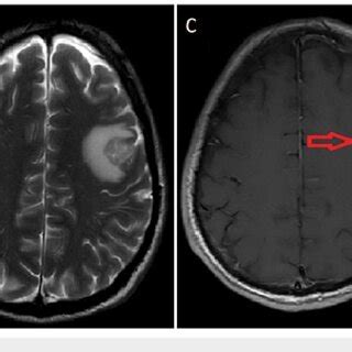 MRI Brain Images A And B Pre Treatment Brain MRI T1 And T2 Weighted