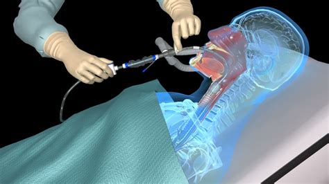 Tracheostomy Tube Suctioning