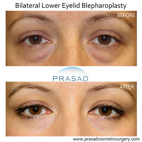 Lower Blepharoplasty Recovery Process Dr Prasad Blog