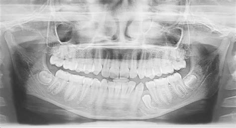 Followup Orthopantomograph Radiograph Of Patient After 9 Months