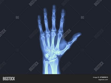 X-rayed Human Hand. X- Image & Photo (Free Trial) | Bigstock