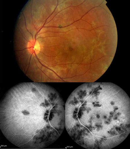 Case Of Amppiginous Choroiditis Disease Started As Apmppe Amic Lesions