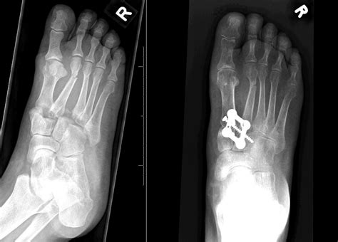 www.lisfranc.ca - Lisfranc Fracture / Injury Blog