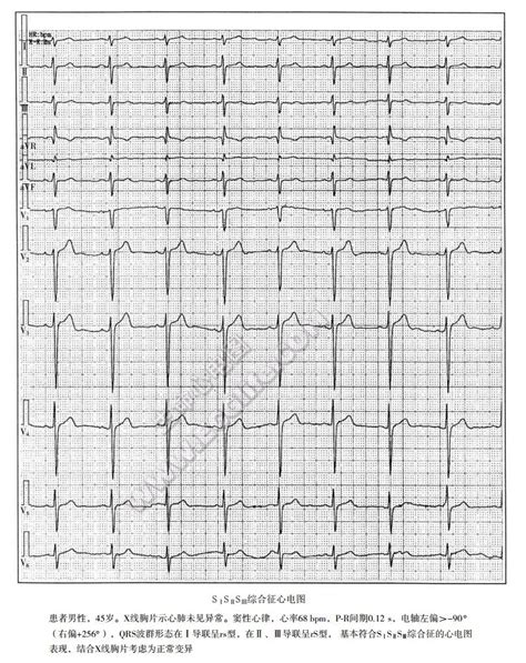 【附图】3s综合征心电图表现心血管综合征学 天山医学院