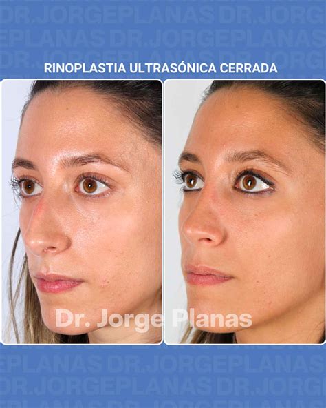 Rinoplastia Ultrasónica Antes Y Después Resultados Espectaculares