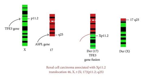 Renal Cell Carcinoma Associated With Xp11 2 Translocation 46 X T X